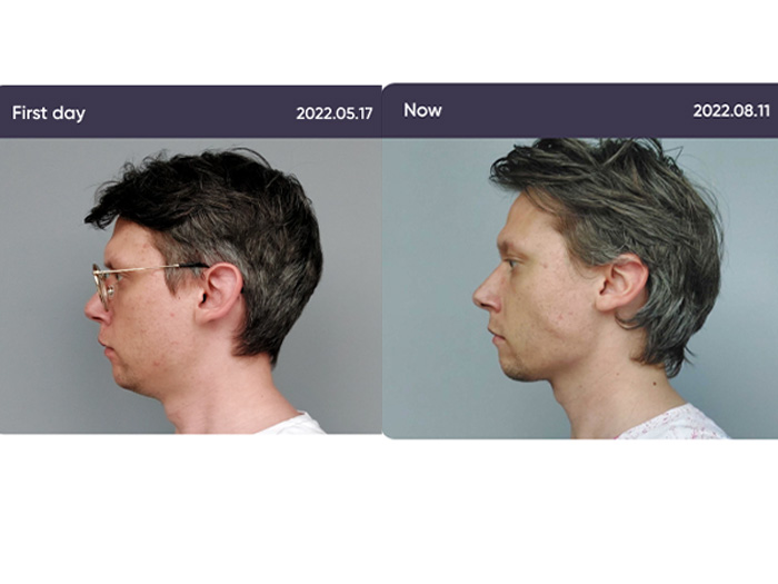 Jawline transformations before and after mewing